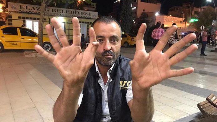 elazigda-11-parmakli-adam-gorenleri-hayrete-dusuruyor-gvQNqybL.jpg