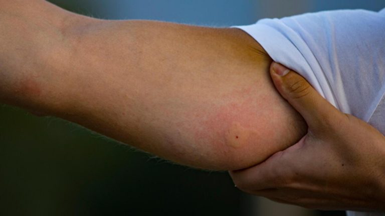 Böcek ısırığı nedeni ile doktora gitti hayatının şokunu yaşadı: ‘Dünyamız yıkıldı, kimsenin başına gelsin istemem’