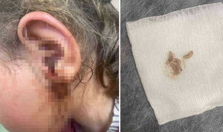 3 yaşındaki çocuğun kulağından 23 adet ‘canlı kurtçuk’ çıkartıldı