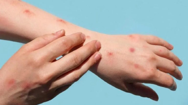 İletişim Başkanlığı paylaştı! İşte maymun çiçeği virüsü ile ilgili merak edilenler
