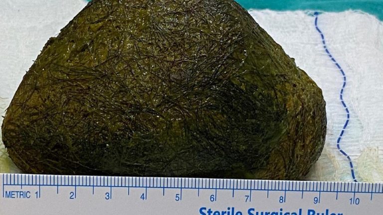 Mide ağrısı için gittiği hastanede karnından 2 kilogram ‘taşlaşmış saç yumağı’ çıkarıldı