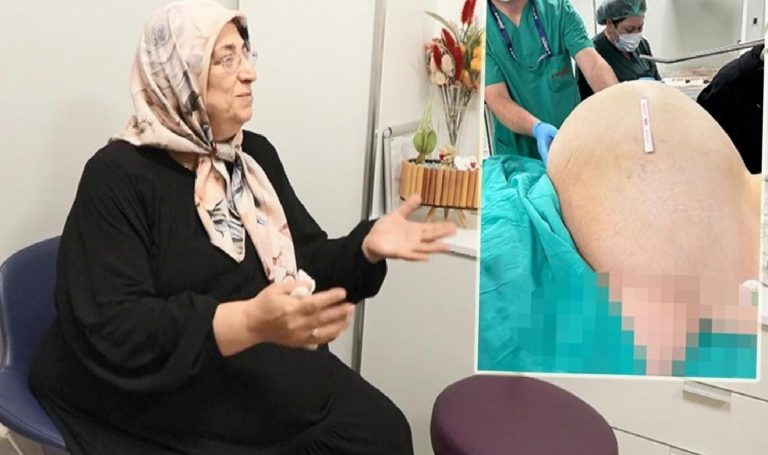 Tabipleri bile şaşırttı: Fobisi yüzünden hastaneye gitmeyen bayanın yumurtalıklarından 23 kiloluk kitle çıkarıldı