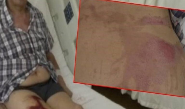 Lavabo açıcı bomba üzere patladı, bedeninin yüzde 40’ı yandı