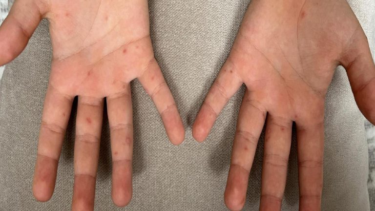 Kızamık ve su çiçeği ile karıştırılıyor: El ayak ağız hastalığı nedir, nasıl bulaşır?
