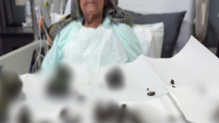 Doktorlar şaşırdı: 92 yaşındaki kadının midesinden onlarca hurma ve zeytin çekirdeği ile taş çıktı