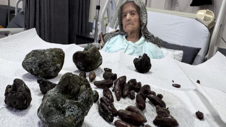Zeytin ve hurma çekirdekleri yuttu, mide ve bağırsakları delindi