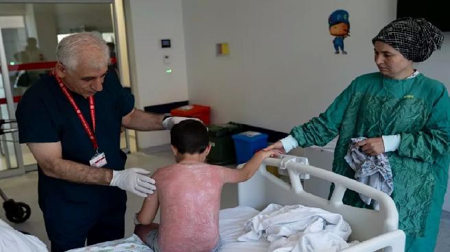 Güneş Yanığına Dikkat: 7 Yaşındaki Çocuk Hastaneye Sevk Edildi